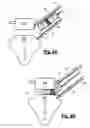 Fig. 03 - Spinal surgical implant and related methods