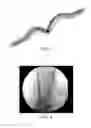 Fig. 03 - Stent apparatus and treatment methods