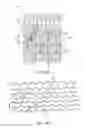 Fig. 06 - Uncaging stent