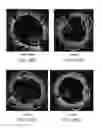 Fig. 134 - Uncaging stent