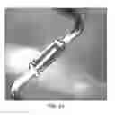 Fig. 69 - Uncaging stent