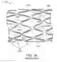 Fig. 79 - Uncaging stent