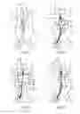 Fig. 04 - Controlled expansion stent graft delivery system