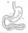 Fig. 01 - Passive caloric bypass device