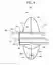 Fig. 10 - Passive caloric bypass device