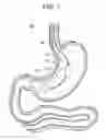 Fig. 11 - Passive caloric bypass device