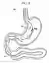 Fig. 13 - Passive caloric bypass device