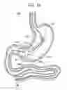 Fig. 14 - Passive caloric bypass device