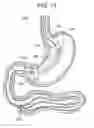Fig. 15 - Passive caloric bypass device
