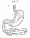 Fig. 16 - Passive caloric bypass device