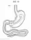 Fig. 17 - Passive caloric bypass device