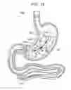 Fig. 18 - Passive caloric bypass device