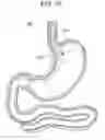 Fig. 19 - Passive caloric bypass device