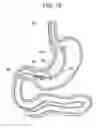 Fig. 20 - Passive caloric bypass device