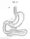 Fig. 21 - Passive caloric bypass device