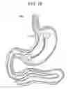Fig. 22 - Passive caloric bypass device