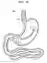 Fig. 23 - Passive caloric bypass device