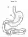 Fig. 26 - Passive caloric bypass device