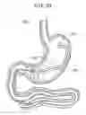Fig. 27 - Passive caloric bypass device