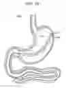 Fig. 28 - Passive caloric bypass device