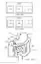 Fig. 12 - Intestinal devices and methods for facilitating weight loss