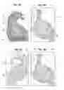 Fig. 06 - Forefoot Orthotic Device
