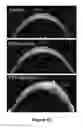 Fig. 09 - METHODS OF REDUCING CORNEAL ENDOTHELIAL CELL LOSS