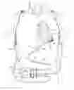 Fig. 01 - Percutaneous driveline anchor devices and methods of use