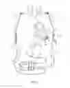 Fig. 02 - Percutaneous driveline anchor devices and methods of use