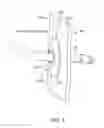 Fig. 06 - Percutaneous driveline anchor devices and methods of use