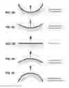 Fig. 15 - Patient interface with volume reducing member