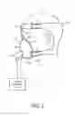 Fig. 02 - PATIENT INTERFACE DEVICE FABRIC SUPPORT SLEEVE