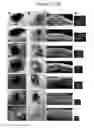 Fig. 06 - Nanosecond pulsed electric fields cause melanomas to self-destruct