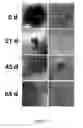 Fig. 08 - Nanosecond pulsed electric fields cause melanomas to self-destruct
