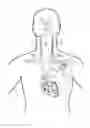 Fig. 01 - Implantable neurostimulator-implemented method for managing bradycardia through vagus nerve stimulation