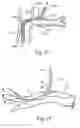 Fig. 08 - Endoscopic sympathectomy systems and methods