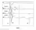 Fig. 09 - Analyzing and mapping ECG signals and determining ablation points to eliminate Brugada syndrome