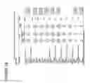 Fig. 22 - Analyzing and mapping ECG signals and determining ablation points to eliminate Brugada syndrome