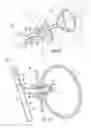 Fig. 09 - Necrosectomy devices and procedures