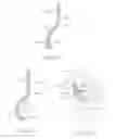Fig. 12 - Method and apparatus for altering biomechanics of articular joints