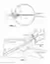 Fig. 03 - Contrast agent to assess quality of occlusion through impedance measurement
