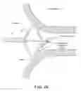 Fig. 05 - Contrast agent to assess quality of occlusion through impedance measurement