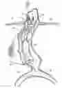 Fig. 01 - Vascular prosthesis for treating aneurysms