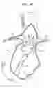Fig. 06 - Vascular prosthesis for treating aneurysms