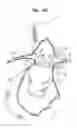 Fig. 07 - Vascular prosthesis for treating aneurysms