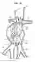 Fig. 08 - Vascular prosthesis for treating aneurysms
