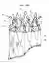 Fig. 22 - Vascular prosthesis for treating aneurysms