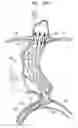 Fig. 35 - Vascular prosthesis for treating aneurysms