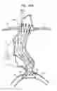 Fig. 41 - Vascular prosthesis for treating aneurysms