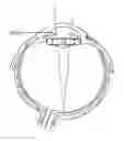 Fig. 01 - Intraocular lens system with folding features